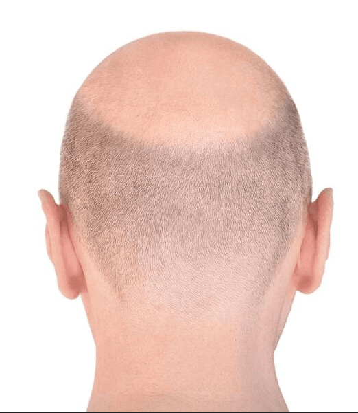 Before treatment