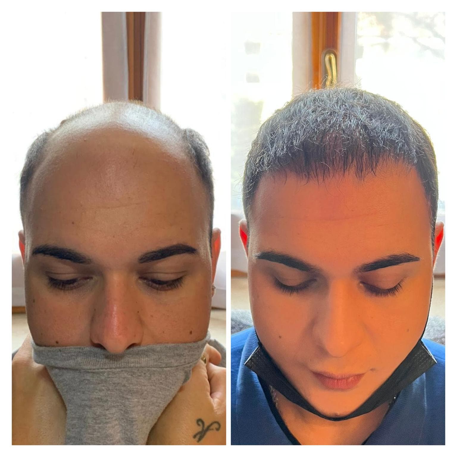 Hair Transplant Result