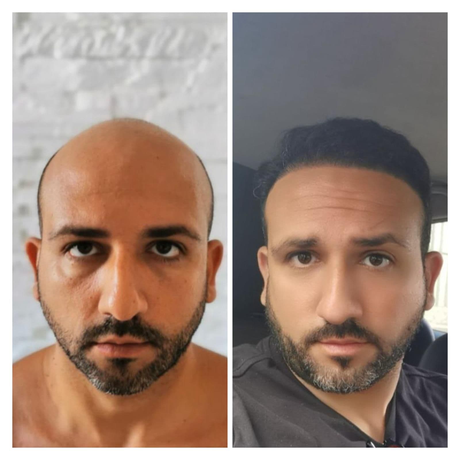 Hair Transplant Result