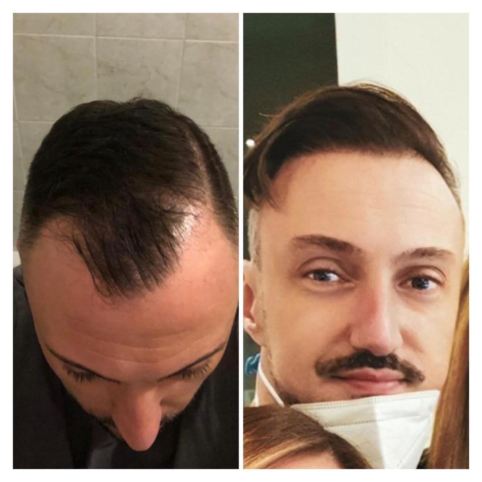 Hair Transplant Result