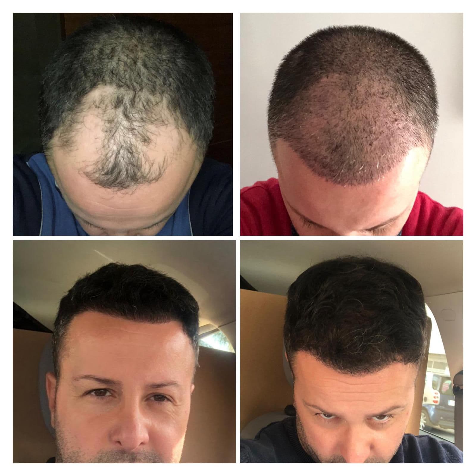 Hair Transplant Result