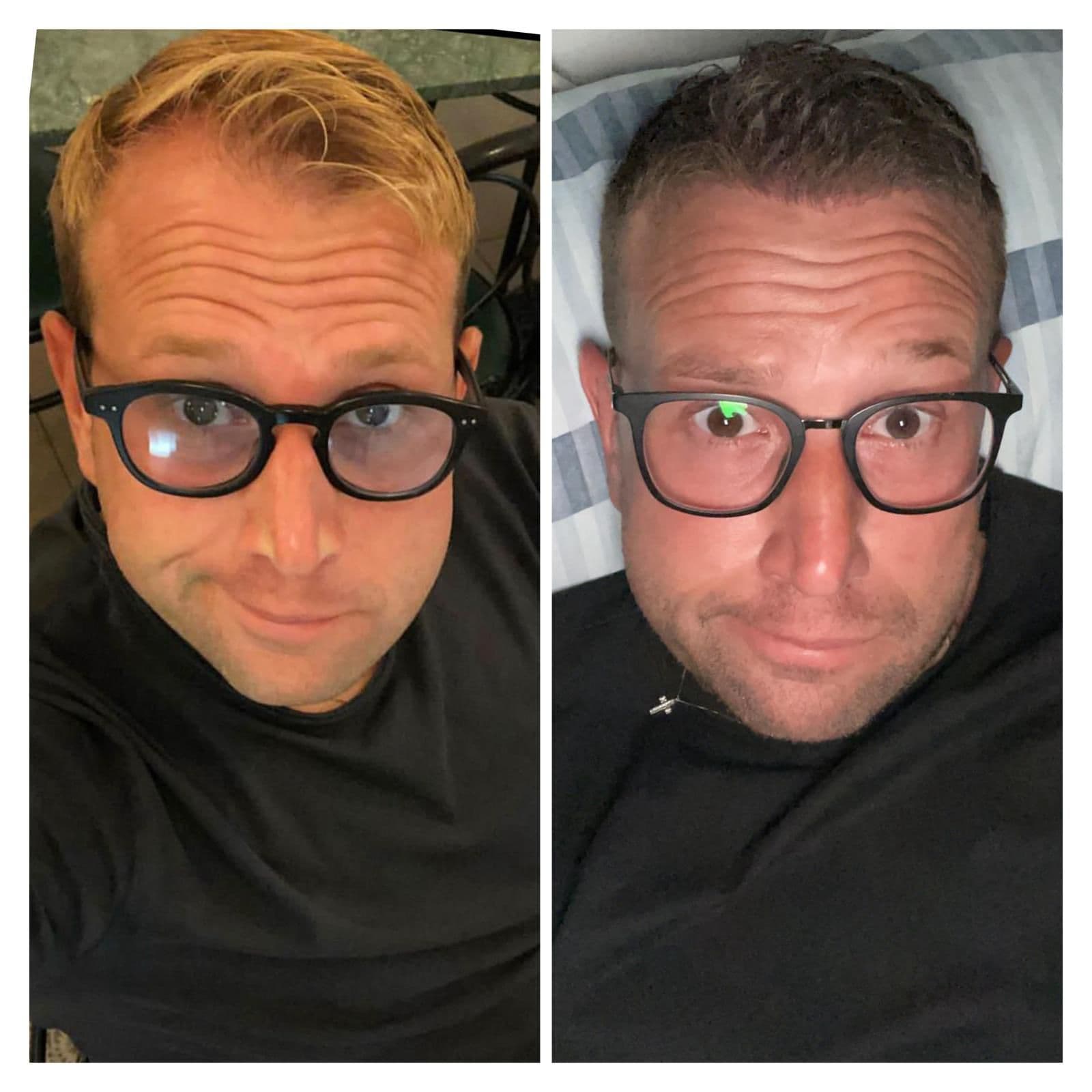 Hair Transplant Result