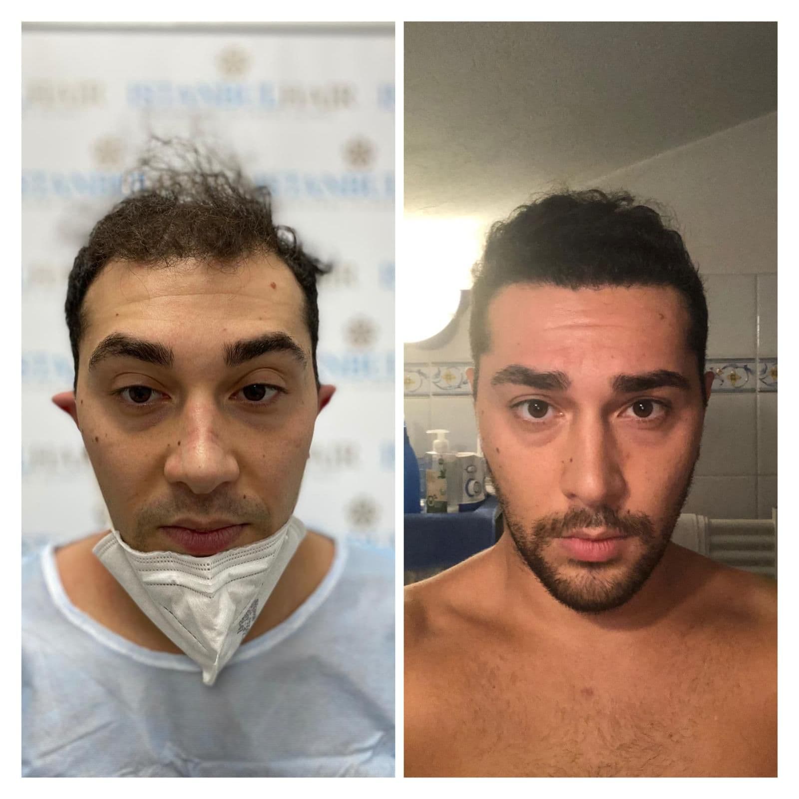Hair Transplant Result