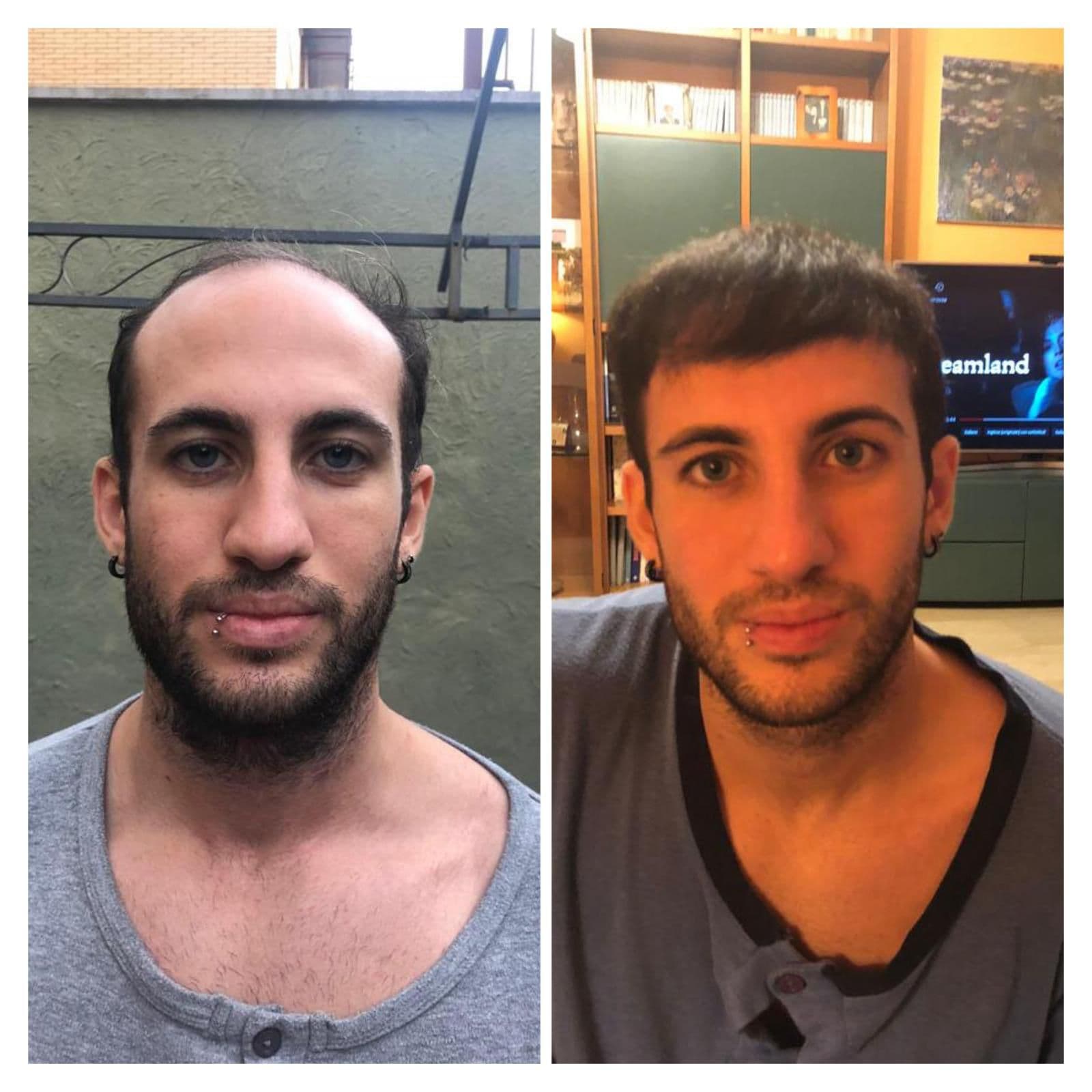 Hair Transplant Result