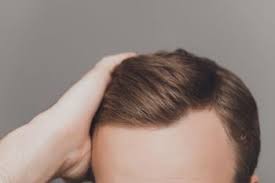 DHI Hair Transplant
