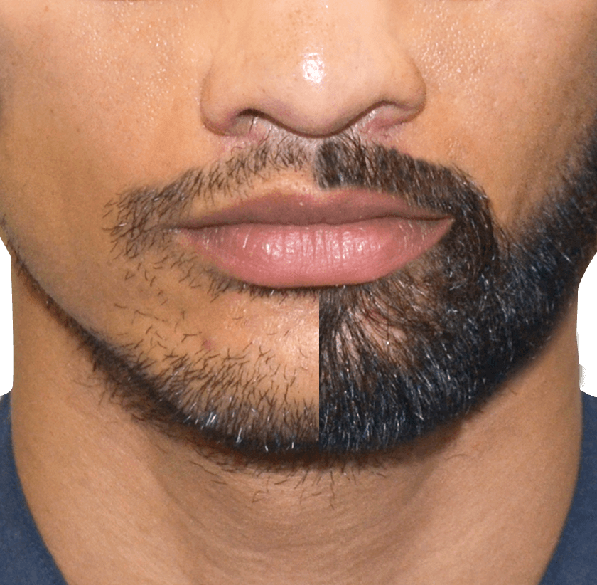 Facial Hair Transplant