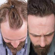 FUE Hair Transplant